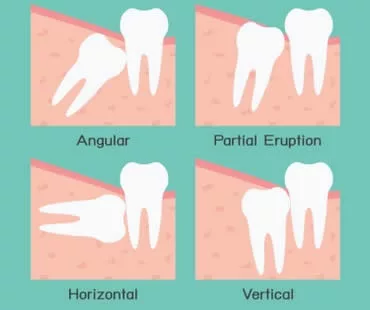 Wisdom Teeth: Should They Stay or Should They Go?
