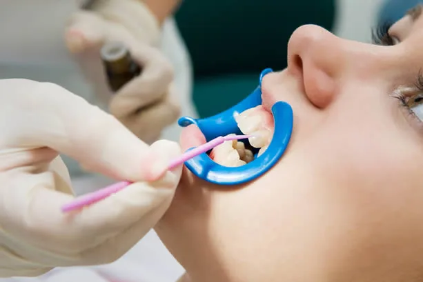 Dental sealants applied to teeth at Allure Family Dental & Specialty Group